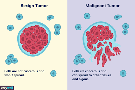 Cancer: Types, Causes, Risk Factors, Symptoms, Stages, Prevention ...