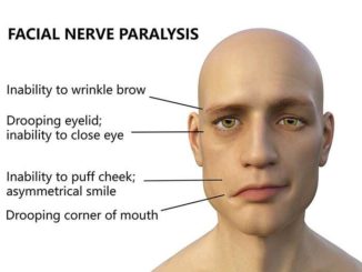 symptoms of facial palsy Archives - Public Health Notes