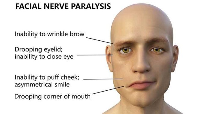 Facial palsy