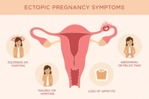 Ectopic pregnancy symptoms