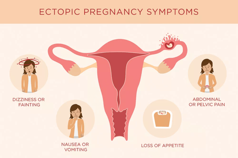 Picture of Ectopic Pregnancy: Causes, Symptoms & Treatment - Public Health Notes