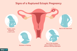 Signs of ruptured ectopic pregnancy