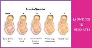 Extent of jaundice in newborns