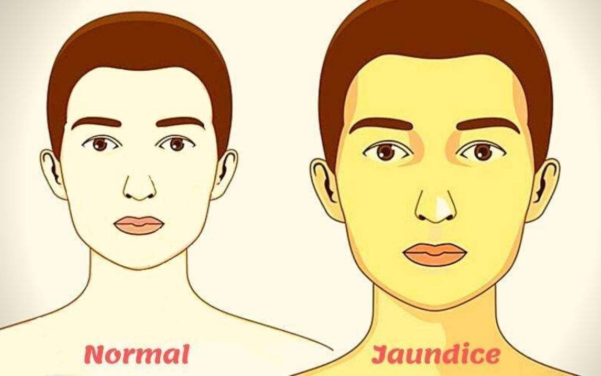 Jaundice Causes Symptoms Treatment Public Health Notes Jaundice Causes Symptoms Treatment Public Health Notes