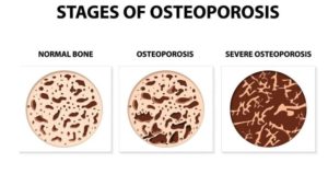 stages of osteoporosis