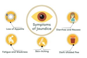 Symptoms of jaundice