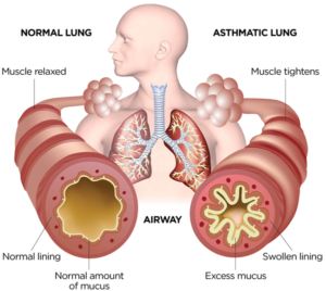 asthmic lung