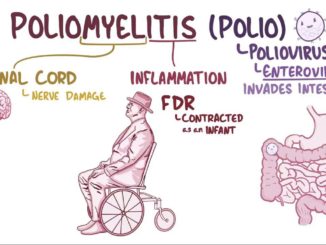 stages of polio Archives - Public Health Notes