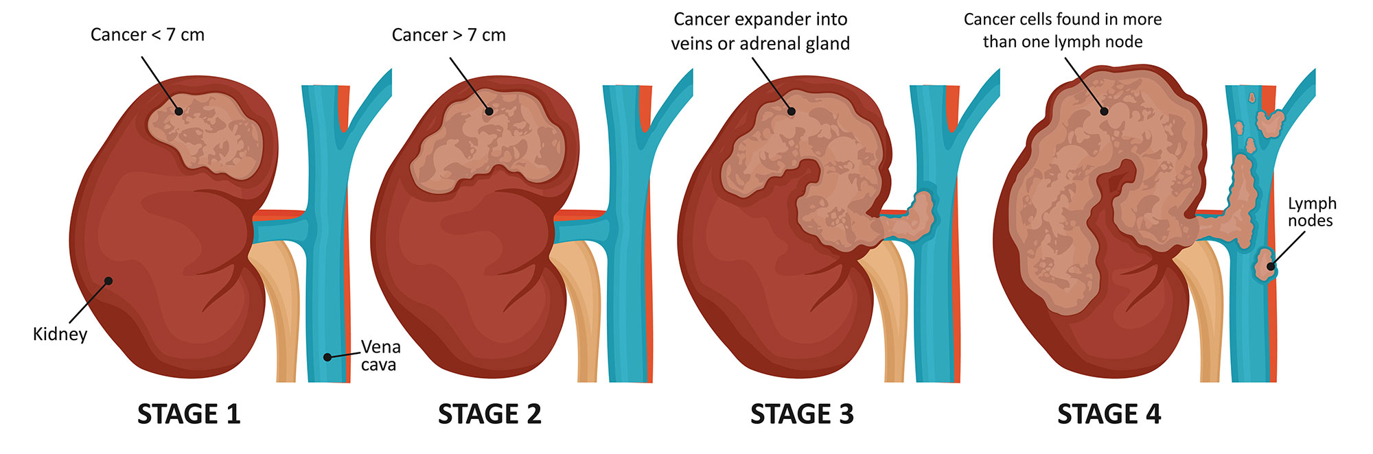 Stages Of Kidney Cancer Public Health Notes Stages Of Kidney Cancer Public Health Notes